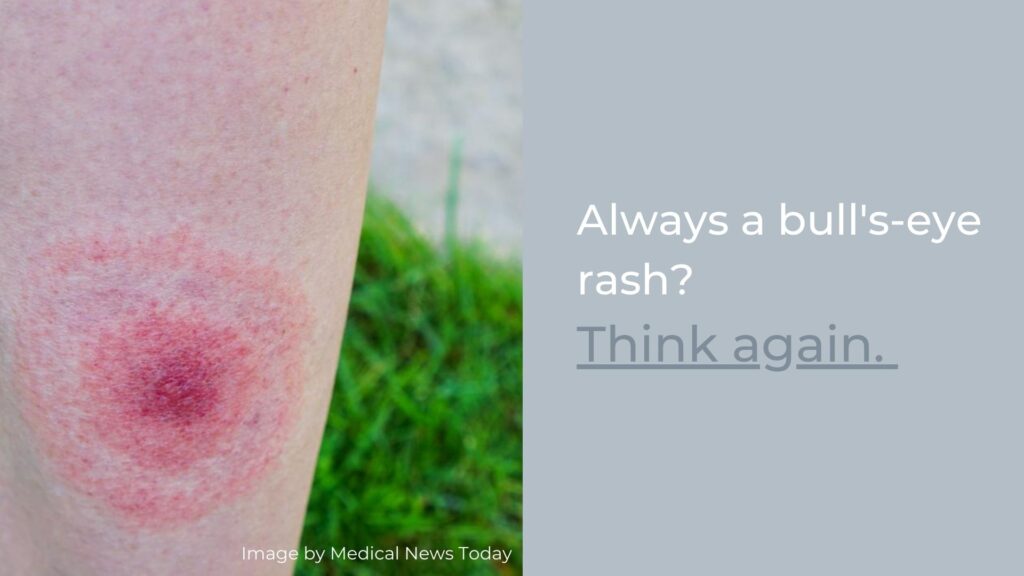 Always a Bull's eye rash? Think again. 