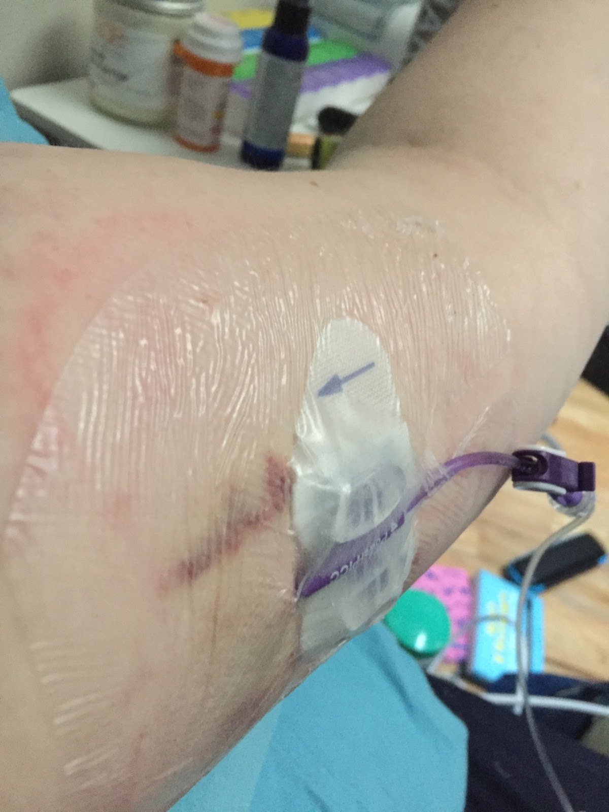 PICC line in arm