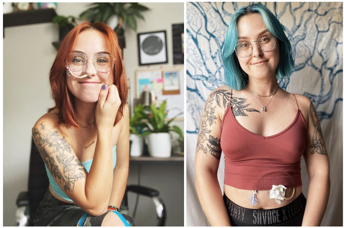 Side-by-side photos of a bespectacled woman smiling, with naso-jejunal and gastro-jejunal feeding tubes.